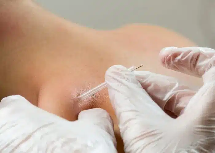 Dry Needling Treatment at Thephysiofx